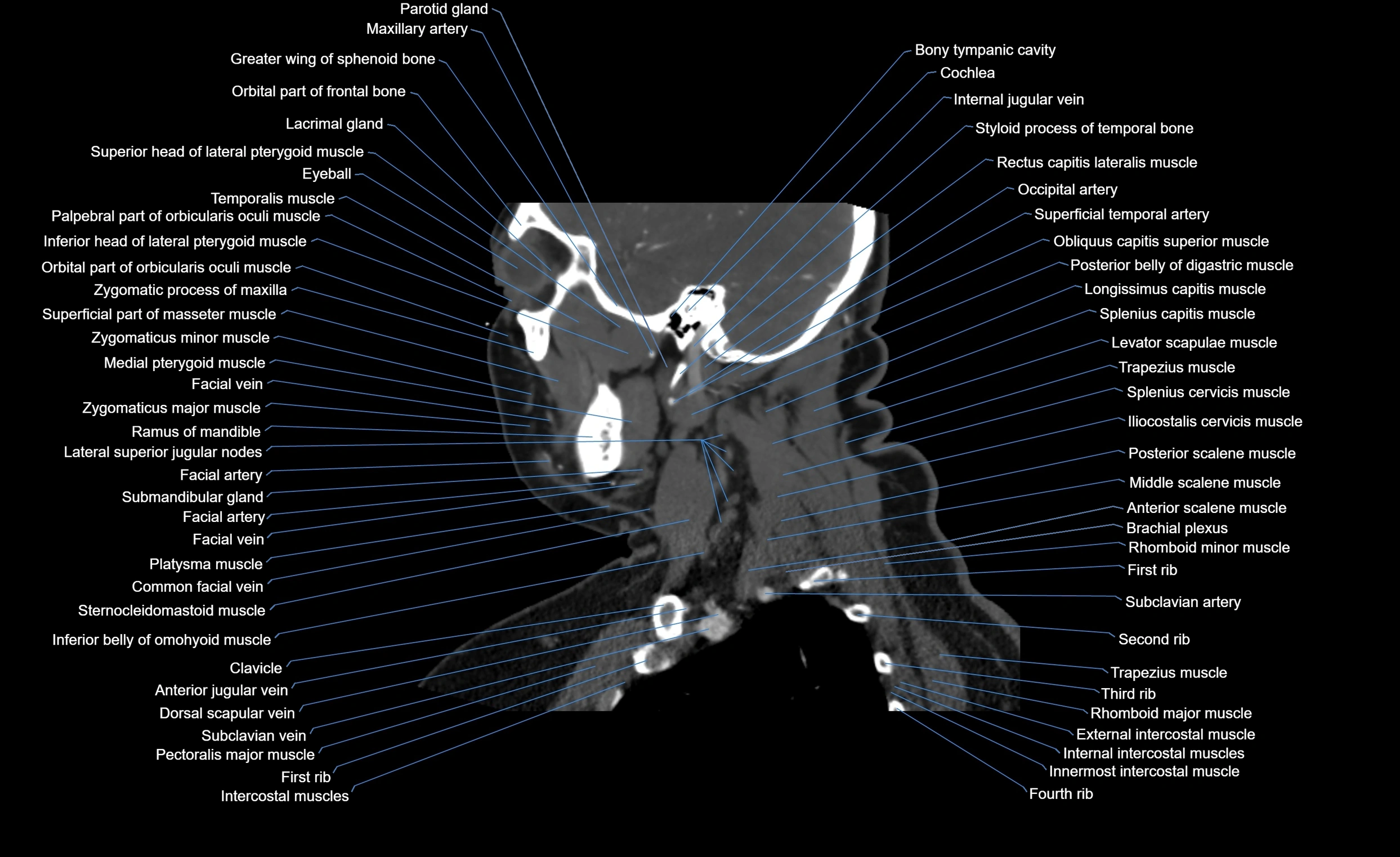 Neck CT sagittal cross sectional anatomy 3D  radiology  image-img-00001-00014.webp